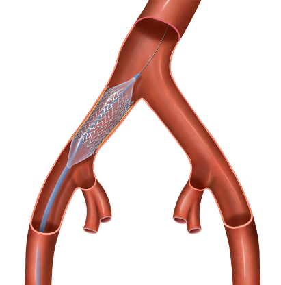 Iliac stent