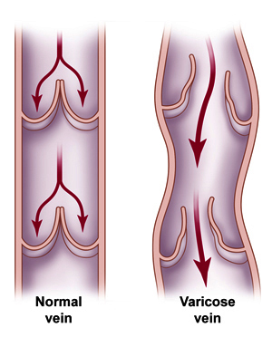 Normal%20vs%20Variocse%20vein